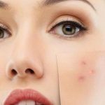 مكافحة حب الشباب بالعلاجات المنزلية.. 8 حلول
