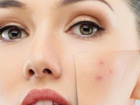 مكافحة حب الشباب بالعلاجات المنزلية.. 8 حلول