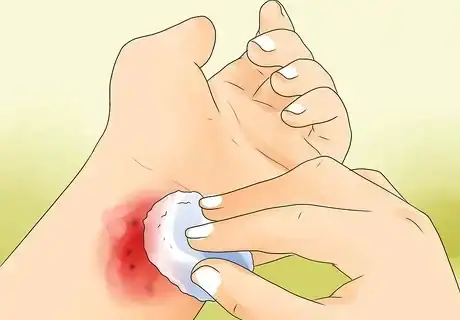 علاج السحجات في المنزل..6 طرق طبيعية
