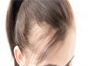 انحسار خط الشعر: أسبابه وطرق علاجه..وفقًا للخبراء