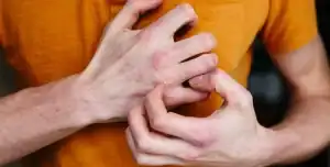 الأكزيما