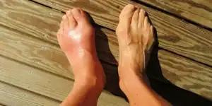 النقرس