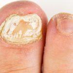 هل امراض الاظافر وحالات الحثل مؤشر على الحالة الصحية للجسم ؟..تفاصيل