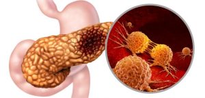 4 علامات في الساق قد تكشف عن سرطان البنكرياس..احذريها 