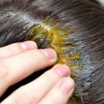 طريقة "بسيطة" لعلاج تساقط الشعر