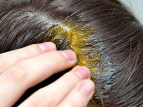 طريقة "بسيطة" لعلاج تساقط الشعر