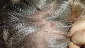 لماذا تظهر الحبوب على فروة الرأس وكيف نتخلص منها؟