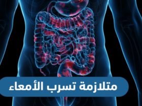 كيفية علاج متلازمة الأمعاء المتسربة: دليل شامل لتحسين صحة الأمعاء
