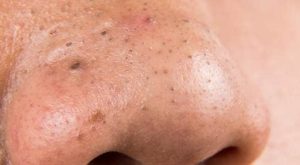 وداعًا للرؤوس السوداء: وصفات منزلية سهلة لبشرة صافية