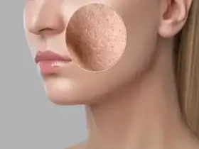 كيفية التخلص من الاحمرار الناتج عن البثور وحب الشباب
