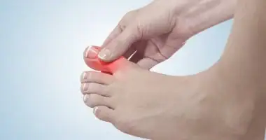 مراحل الإصابة بالنقرس وأعراض كل منها.. تجنبي هذه الأخطاء لتخفيف الألم