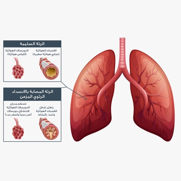 ما هو مرض الانسداد الرئوي المزمن.. الأعراض وطرق العلاج