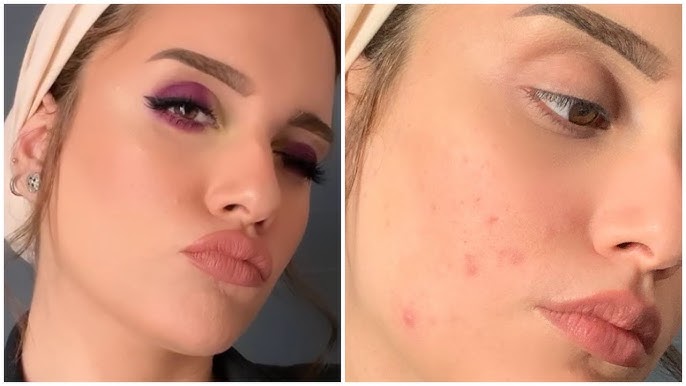 خدعة مكياج بسيطة لإخفاء البثور فورًا كما تفعل خبيرات التجميل