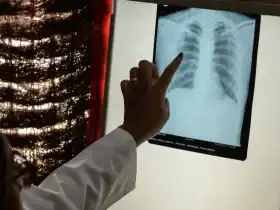 وفقا للخبراء.. هل يمكن الإصابة بسرطان الرئة دون تدخين؟