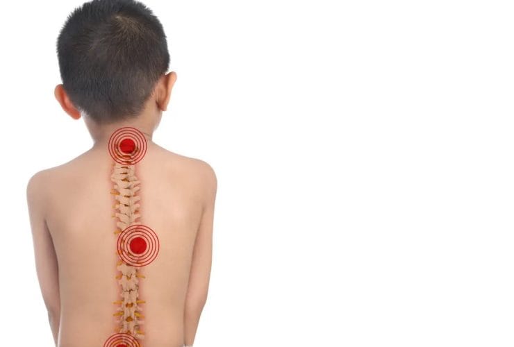 مشاكل العمود الفقري عند الأطفال: دليل شامل