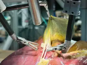 أول عملية جراحية لاستبدال المفصل باستخدام روبوت آلي بالكامل في العالم