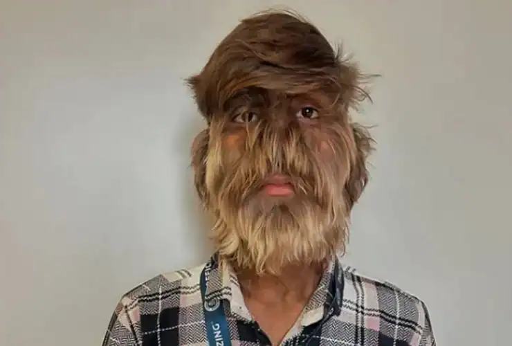 اليت باتيدار.. ومتلازمة المستذئب