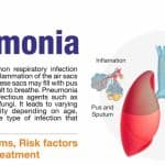 الالتهاب الرئوي.. الأسباب والأنواع وتحديات التشخيص والعلاج