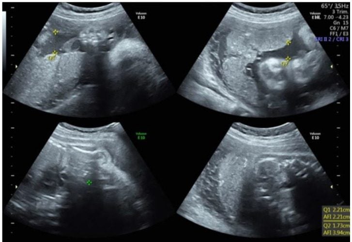 اضطرابات السائل الأمنيوسي.. تحديات التشخيص والإدارة في طب الفترة المحيطة بالولادة