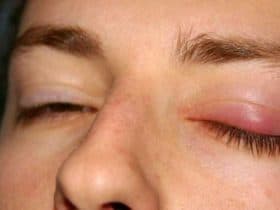 الكيس الدهني في العين (البردة).. الأسباب، الأعراض، وطرق العلاج