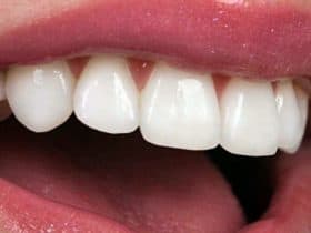 تعرف على اللومينير للأسنان.. ابتسامة مشرقة بلا ألم