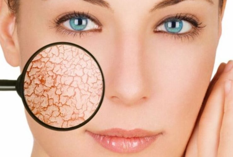 كيفية مكافحة الجفاف البشرة الموسمي.. الأسباب وطرق علاج .