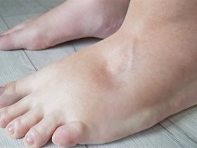 احتباس السوائل .. الأسباب، الأعراض، وطرق التعامل