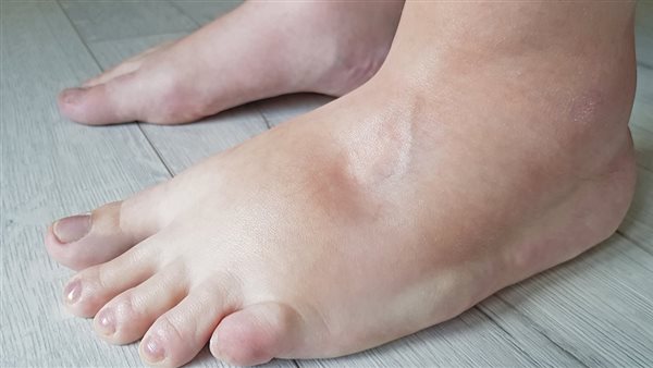  احتباس السوائل .. الأسباب، الأعراض، وطرق التعامل