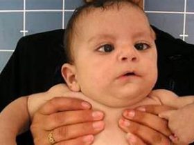 متلازمة موبيوس.. اضطراب خلقي يؤثر على تعبيرات الوجة والإحساس