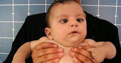 متلازمة موبيوس.. اضطراب خلقي يؤثر على تعبيرات الوجة والإحساس