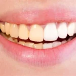اصفرار الأسنان.. تقرير شامل عن الأسباب وسبل العلاج