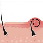 الشعر تحت الجلد.. الأسباب وطرق التخلص منه