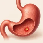 قرحة المعدة وفقر الدم.. علاقة طبية قد تمر دون ملاحظة