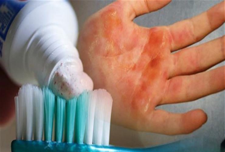 الحروق المنزلية.. احذرمن "خرافة" معجون الأسنان؟ وكيف تسعف نفسك بشكل صحيح؟