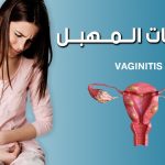 التهاب المهبل.. طرق العلاج، واستراتيجيات الوقاية