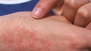 الحمى المالطية.. مرض بكتيري ينتقل من الحيوانات ويهدد الإنسان بمضاعفات خطيرة
