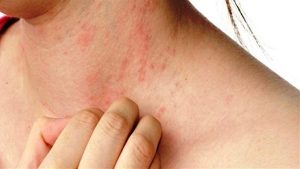 حمو النيل في الصيف.. 10 طرق فعالة لتخفيف الأعراض وتسريع التعافي