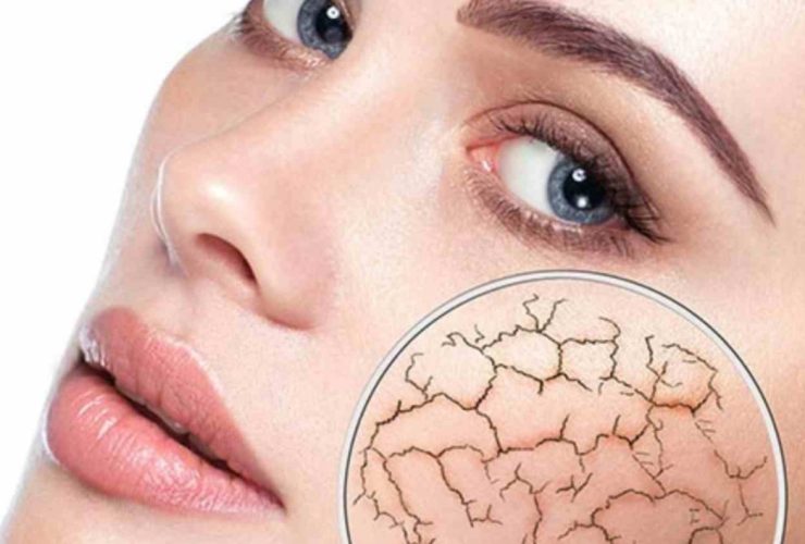 الجفاف.. دليل شامل لفهم علاماته، أسبابه وطرق الوقاية منه