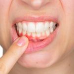 التهاب اللثة التقرحي.. مرض نادر قد يهدد الأسنان إذا أُهمل علاجه