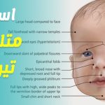 متلازمة تيرنر.. الدليل الشامل للأعراض ومراحل التشخيص الطبية
