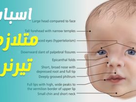 متلازمة تيرنر.. الدليل الشامل للأعراض ومراحل التشخيص الطبية