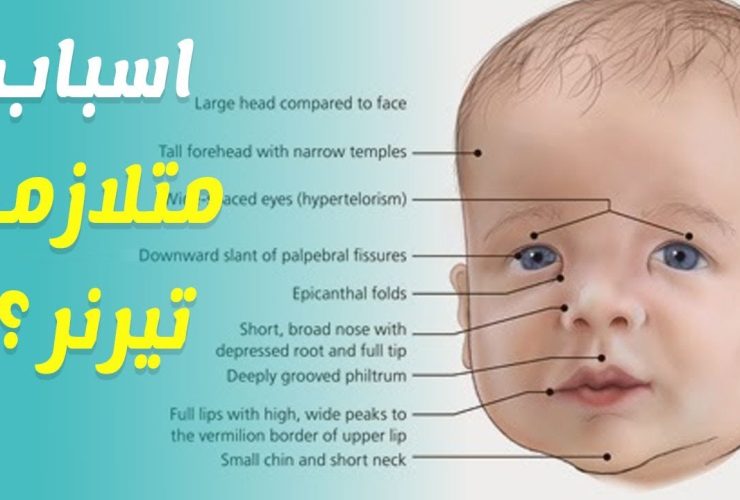 متلازمة تيرنر.. الدليل الشامل للأعراض ومراحل التشخيص الطبية