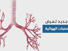 توسع القصبات الهوائية.. فهم المرض، أعراضه، واستراتيجيات التعايش معه