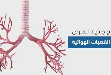 توسع القصبات الهوائية.. فهم المرض، أعراضه، واستراتيجيات التعايش معه