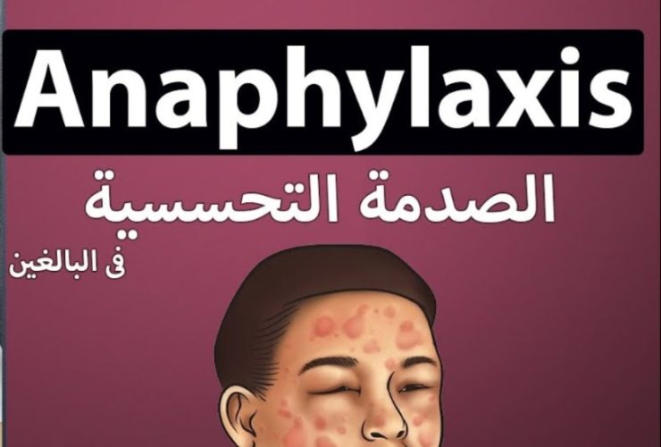 إجراءات فورية وخطوات وقائية للتعامل مع الصدمة التحسسية.. دليل شامل
