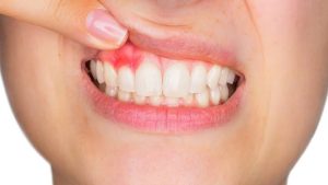 التهاب اللثة.. أسباب شائعة وعلامات تستدعي زيارة طبيب الأسنان