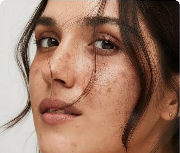 الكلف والتصبغات الجلدية.. كيف يمكن الحد منها واستعادة نضارة البشرة؟