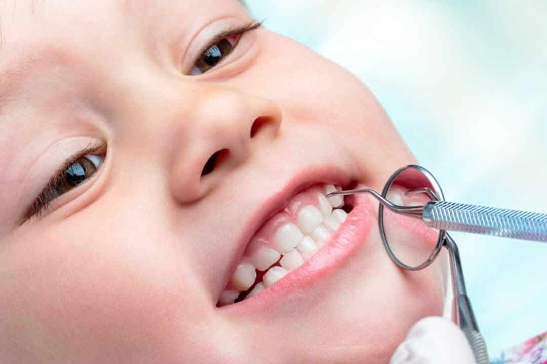 تسوس أسنان الأطفال.. المملكة تسجل أعلى معدل للإصابة بنسبة 93%