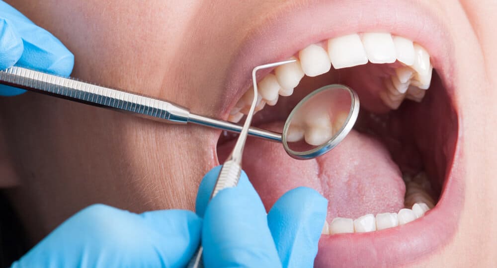 علاج جير الأسنان الأسود وأسبابه