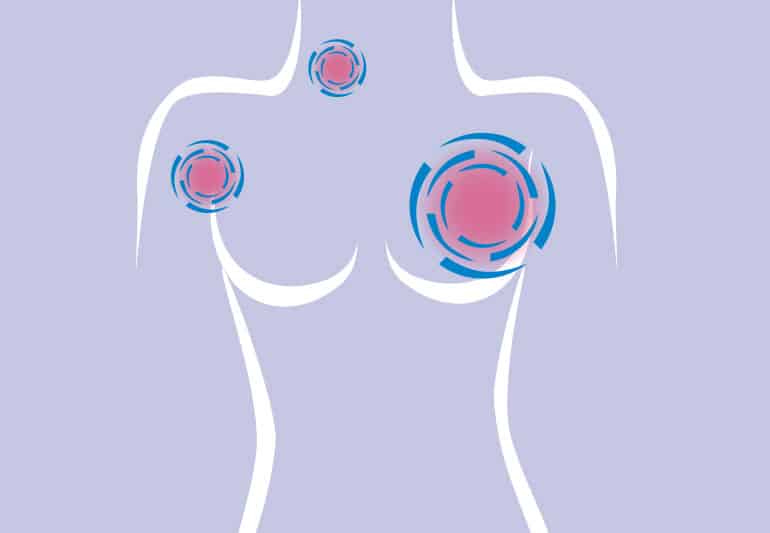 ما هي مرحلة سرطان الثدي التي تتطلب استئصال ؟